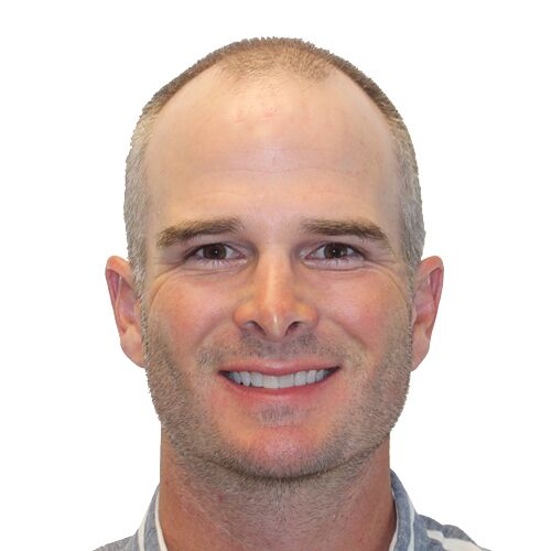 Kevin Streelman's Before Hair Transplant photo