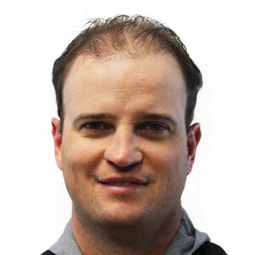 Zach Johnsons Before Hair Transplant photo