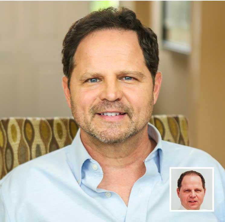 Robert L's Hair Transplant Result