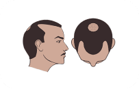 Norwood Scale Class 3