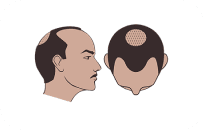 Norwood Scale Class 4