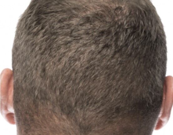 RESTORE FUE Hair Transplant Method RESTORE FUE Hair Transplant Method