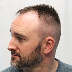 Client Daniel T. Progress Photos Day 3 Client Daniel T. Progress Photos Day 3