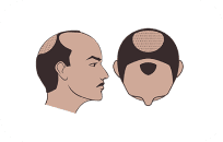 Norwood Scale Class 5 Norwood Scale Class 5
