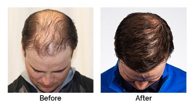 Zach Johnson Before and after Results RESTORE Hair Zach Johnson Before and after Results RESTORE Hair