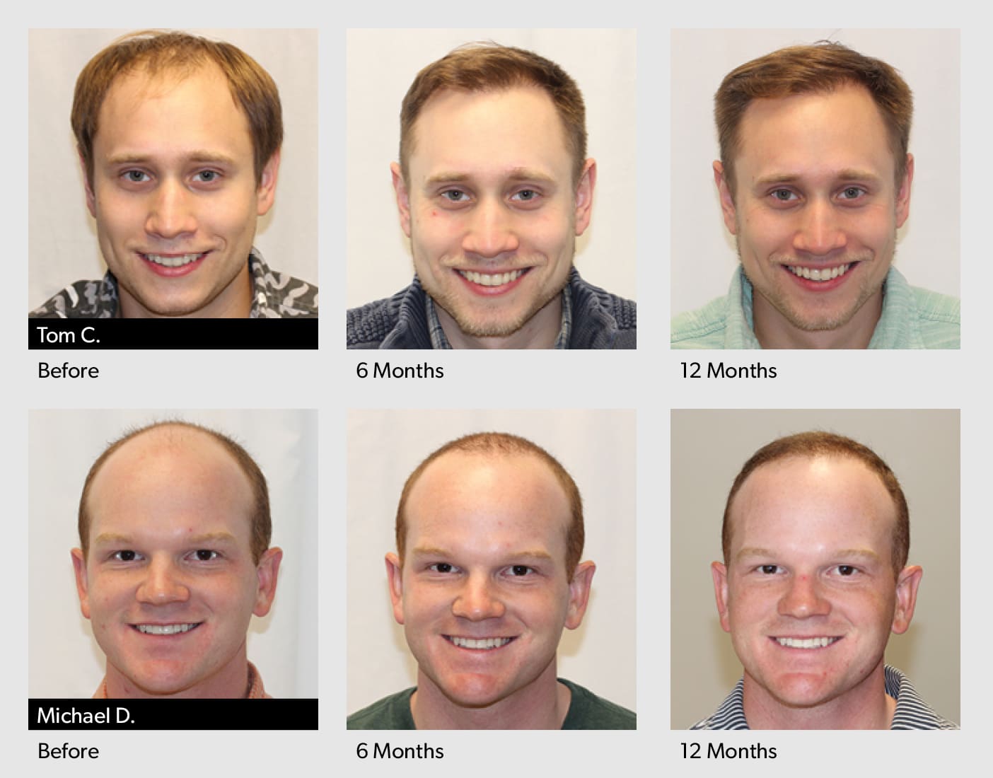 FUE Hair Transplant Progress photos FUE Hair Transplant Progress photos