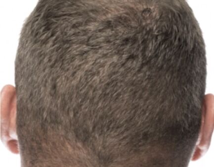 RESTORE FUE Hair Transplant Method