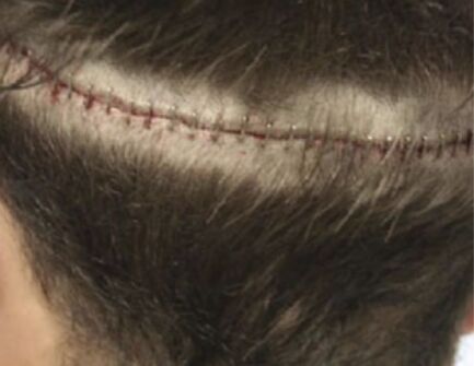 FUT Hair Transplant Scar