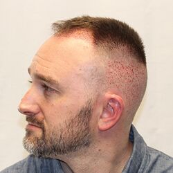 Client Daniel T. Progress Photos Day of procedure