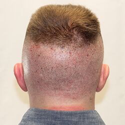 Client Daniel T. Progress Photos Day 10