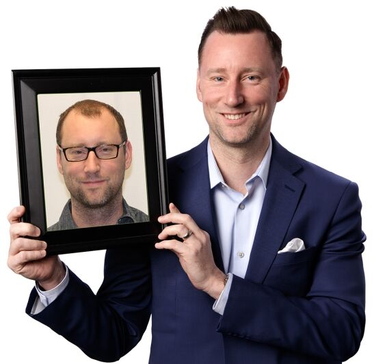 Jake W Before and After hair transplant