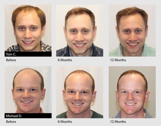 FUE Hair Transplant Progress photos