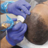scalp-micro-pigmentation-treatment-for-adults-with-treatable-hair-loss