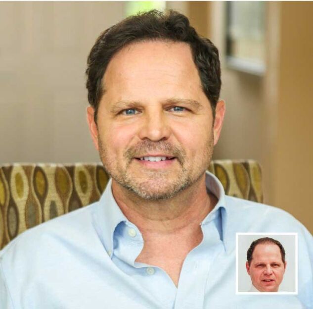 Robert L's Hair Transplant Result Robert L's Hair Transplant Result
