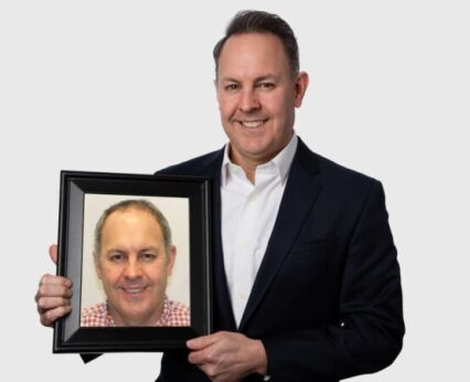 Before and After Hair Transplant result