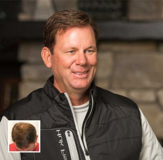 Kevin Vandam's Hair Transplant Result Kevin Vandam's Hair Transplant Result