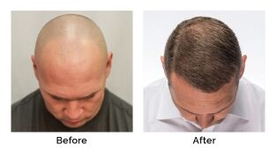 brian urlacher before and after